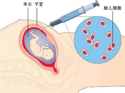 羊水穿刺亲子鉴定